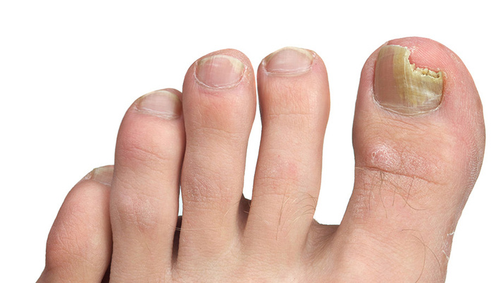 Onimicosis Infección en las uñas de los pies  Clínica Vascular Marbella   Cirujano Vascular en Marbella