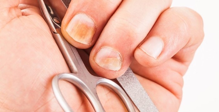 aparición de hongos en las uñas